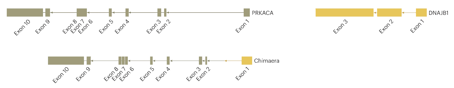 Gen de fusión DNAJB1-PRKACA